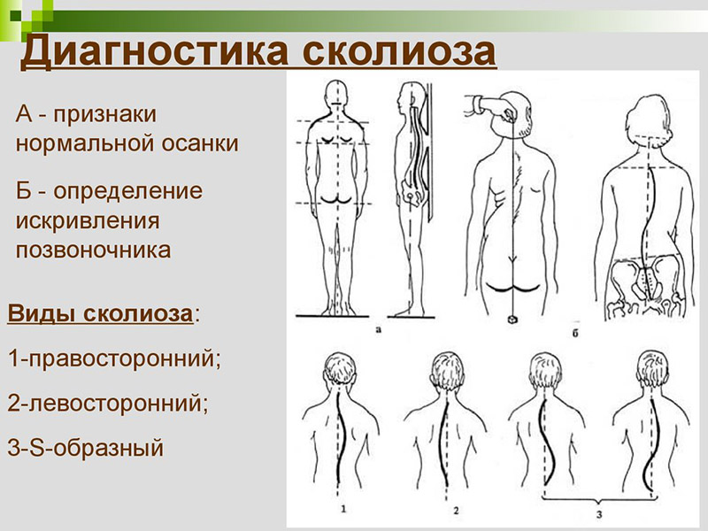 Сколиоз у детей картинки